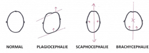 Deformations-crane-bebe